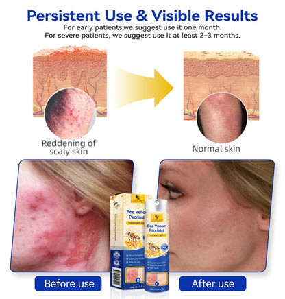 ✅ Official store: 🐝Furzero™PsoriaHeal psoriasis Spray 🐝✨👨‍⚕️ Approved by the American Association of Dermatology (AAOS) (for itchy skin, dry, itchy, redness, scales, eczema, rash, skin inflammation, etc.)