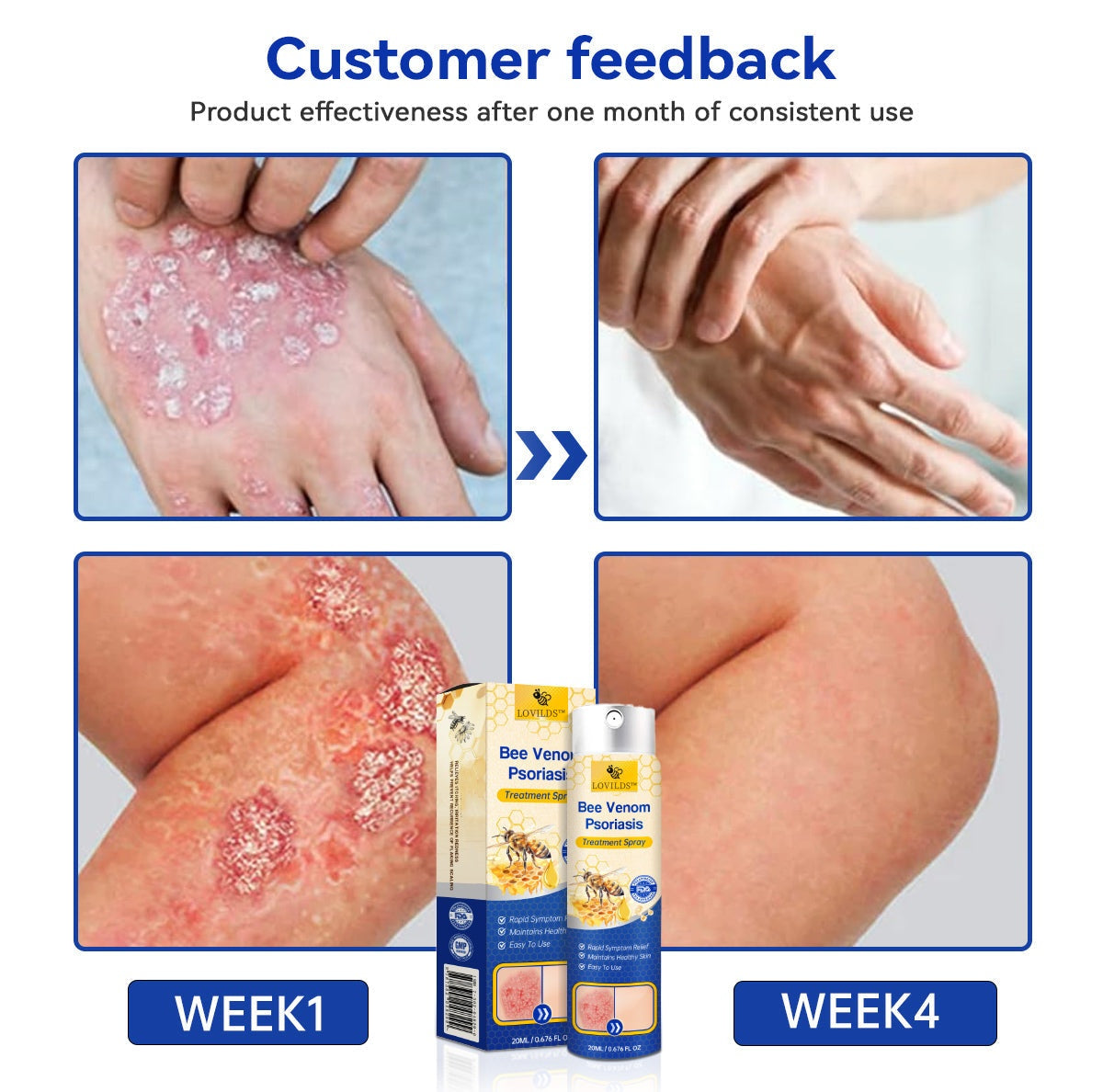 ✅ Official store: 🐝Furzero™PsoriaHeal psoriasis Spray 🐝✨👨‍⚕️ Approved by the American Association of Dermatology (AAOS) (for itchy skin, dry, itchy, redness, scales, eczema, rash, skin inflammation, etc.)