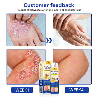 ✅ Official store: 🐝Furzero™PsoriaHeal psoriasis Spray 🐝✨👨‍⚕️ Approved by the American Association of Dermatology (AAOS) (for itchy skin, dry, itchy, redness, scales, eczema, rash, skin inflammation, etc.)